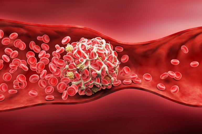 3D illustration of a blood clot, Thickened Arteries and Veins, Red Blood Cells, 3d illustration.