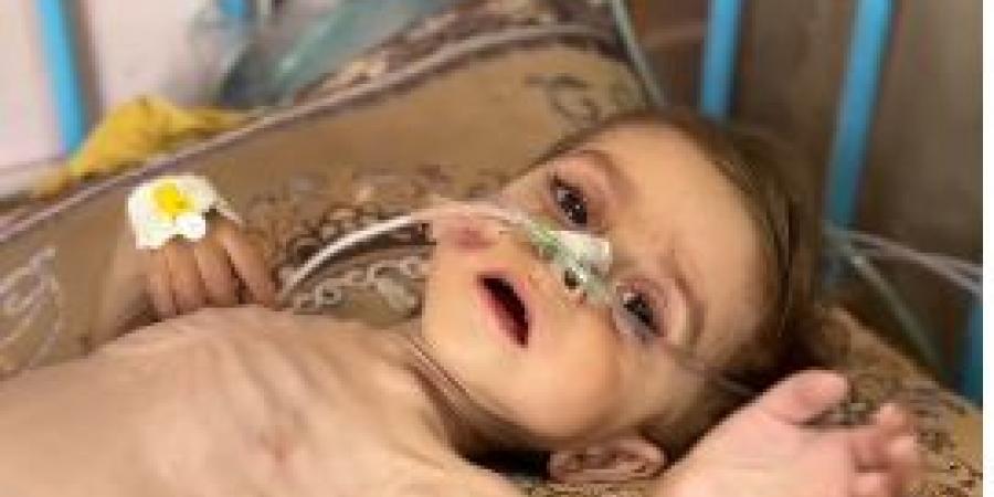 كريم معمر.. سوء التغذية يتسبب في تضخم بالكبد ولا أدوية بمستشفيات غزة - زاجل الإخباري