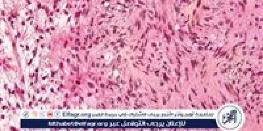الشخير المستمر قد يخفي ورمًا نادرًا في الأنف.. ما هو الورم العصبي الشمي؟ - زاجل الإخباري