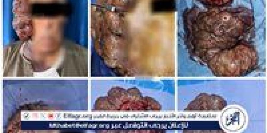 فريق طبي بجامعة أسيوط ينجح في إجراء جراحة نادرة لاستئصال ورم ضخم بالوجه لمريض - زاجل الإخباري